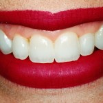 Porcelain Veneers