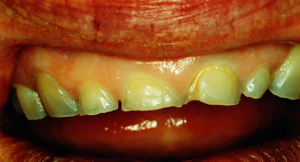 Porcelain Veneers