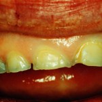 Porcelain Veneers