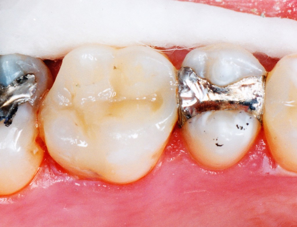 Composite Fillings