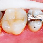 Composite Fillings