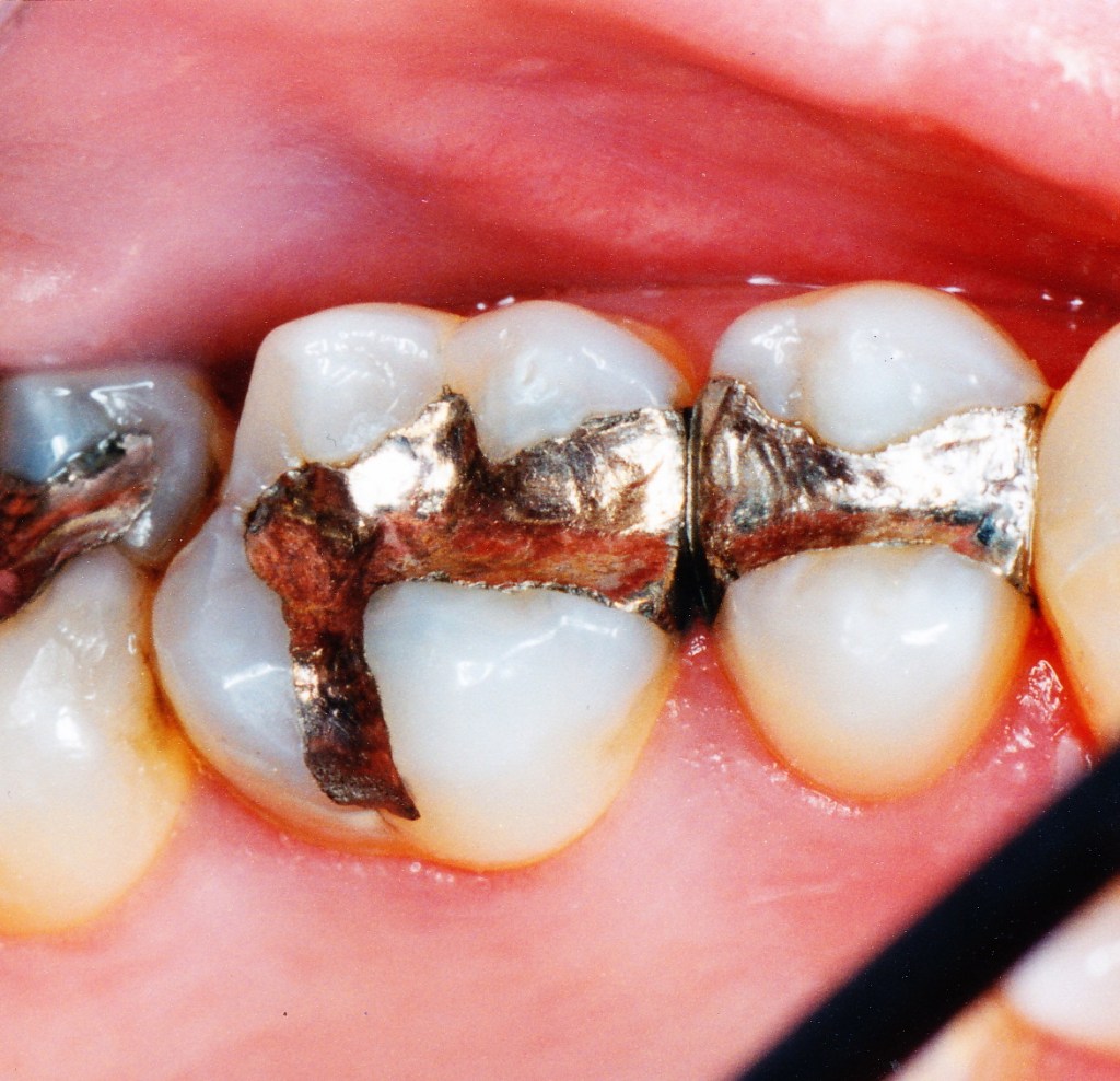 Composite Fillings
