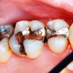Composite Fillings